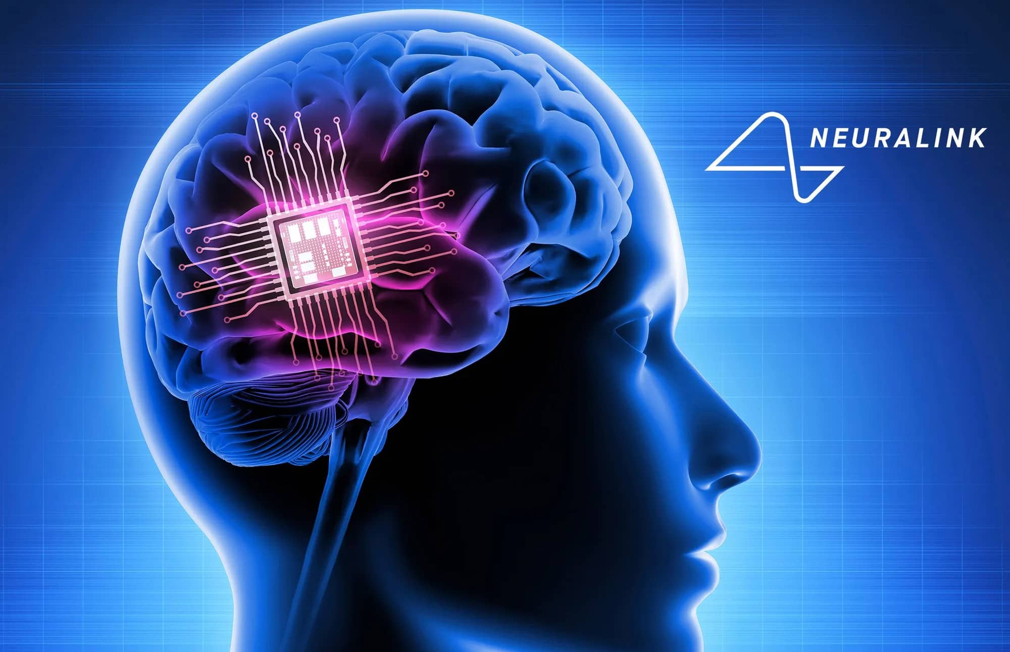 Samsung может начать производство чипов для Neuralink первый контракт с компанией Илона Маска